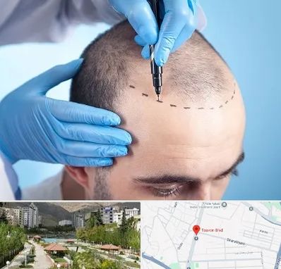 دکتر کاشت مو در بلوار تعاون