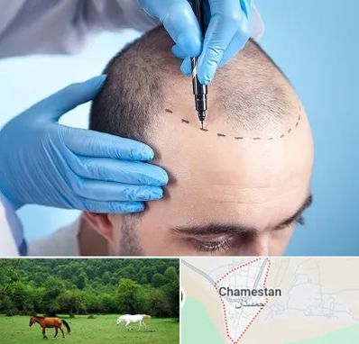 دکتر کاشت مو در چمستان