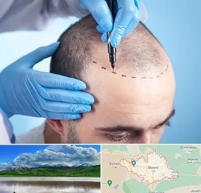 دکتر کاشت مو در مرند