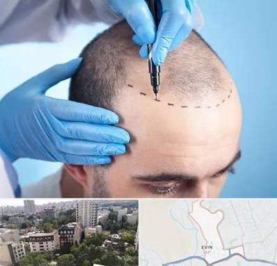 دکتر کاشت مو در اوین