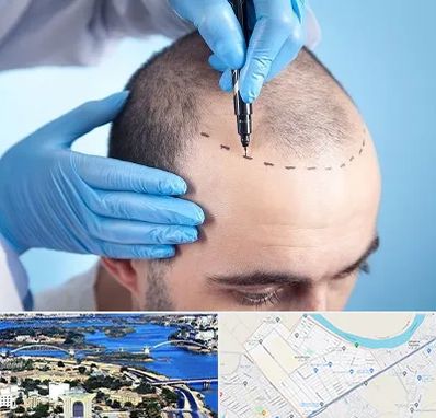 دکتر کاشت مو در کوروش اهواز