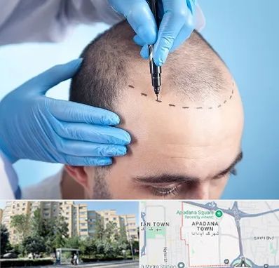 دکتر کاشت مو در آپادانا