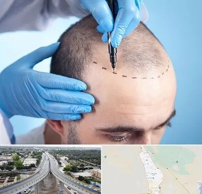 دکتر کاشت مو در اندیمشک