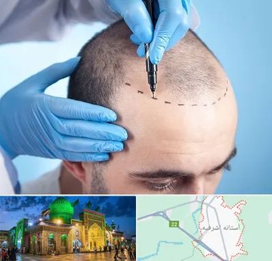دکتر کاشت مو در آستانه اشرفیه