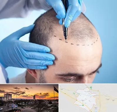 دکتر کاشت مو در قوچان