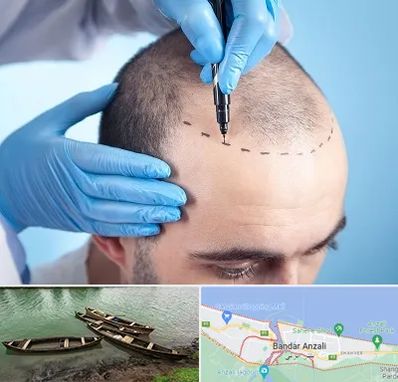 دکتر کاشت مو در بندر انزلی