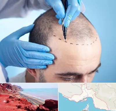 دکتر کاشت مو در هرمزگان