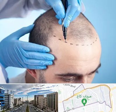 دکتر کاشت مو در سعادت آباد 