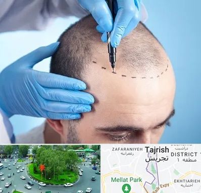 دکتر کاشت مو در تجریش 