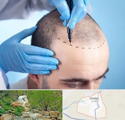 دکتر کاشت مو در کردان