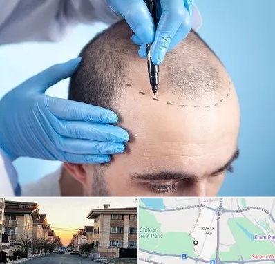 دکتر کاشت مو در کوهک