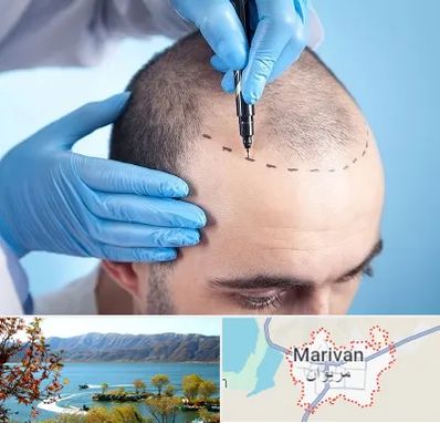 دکتر کاشت مو در مریوان