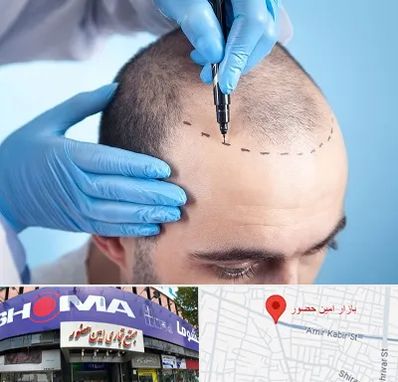 دکتر کاشت مو در امین حضور