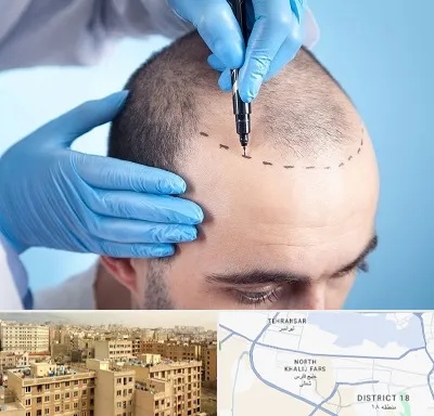 دکتر کاشت مو در جنوب غرب تهران