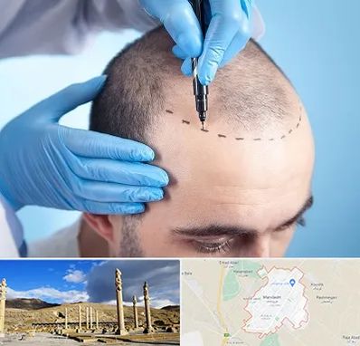 دکتر کاشت مو در مرودشت