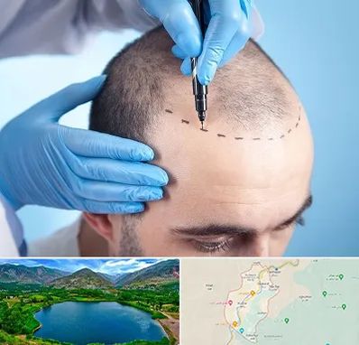 دکتر کاشت مو در رودبار