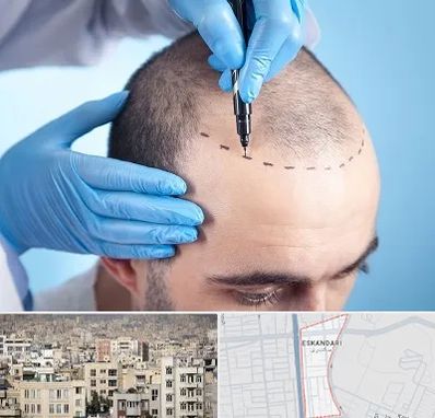 دکتر کاشت مو در اسکندری