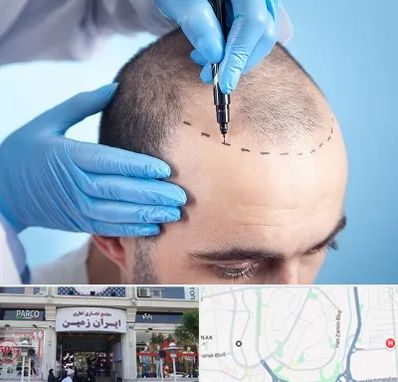 دکتر کاشت مو در ایران زمین