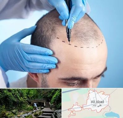 دکتر کاشت مو در علی آباد کتول