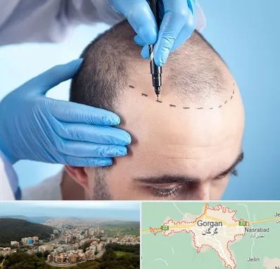 دکتر کاشت مو در گرگان