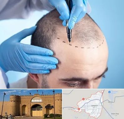 دکتر کاشت مو در ایرانشهر