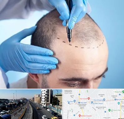 دکتر کاشت مو در پیروزی 