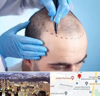 دکتر کاشت مو در جردن 