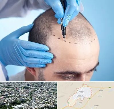 دکتر کاشت مو در شاهرود