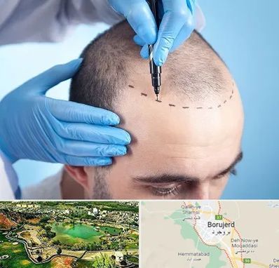 دکتر کاشت مو در بروجرد