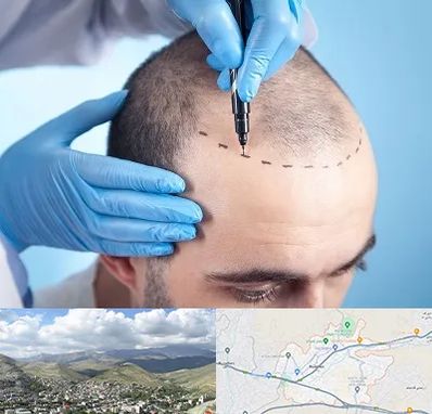 دکتر کاشت مو در رودهن