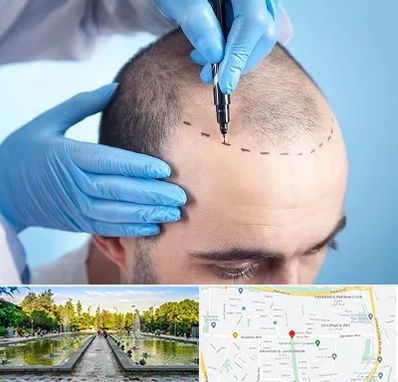 دکتر کاشت مو در سرسبز 