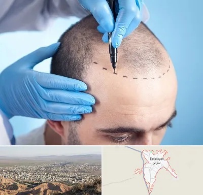 دکتر کاشت مو در اسفراین