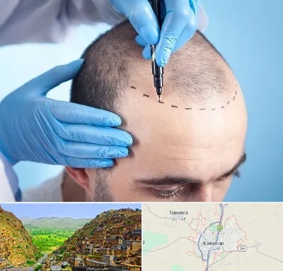 دکتر کاشت مو در کامیاران