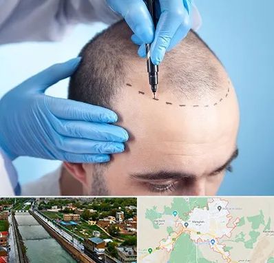 دکتر کاشت مو در مراغه