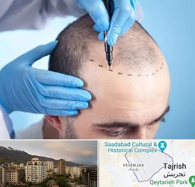 دکتر کاشت مو در زعفرانیه 