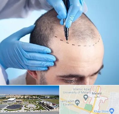 دکتر کاشت مو در ملارد