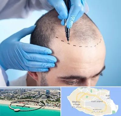 دکتر کاشت مو در کیش