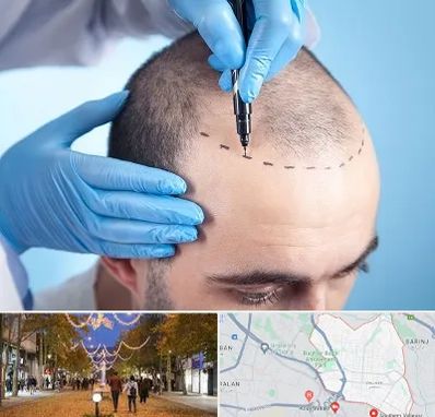 دکتر کاشت مو در ولیعصر ارومیه