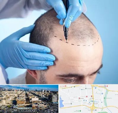 دکتر کاشت مو در شهرک راه آهن