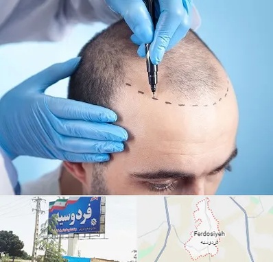 دکتر کاشت مو در فردوسیه شهریار