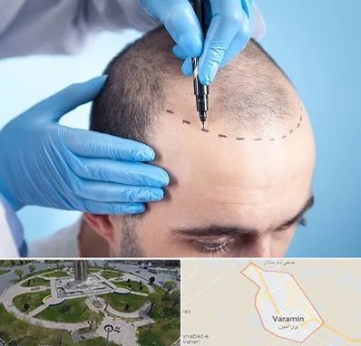 دکتر کاشت مو در ورامین