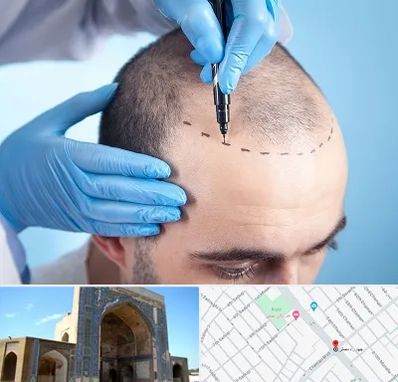 دکتر کاشت مو در مصلی مشهد