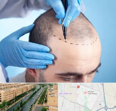 دکتر کاشت مو در فاز سه اندیشه