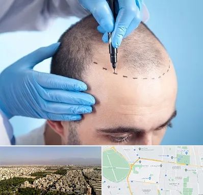 دکتر کاشت مو در نازی آباد 