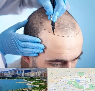 دکتر کاشت مو در منطقه 22 تهران 