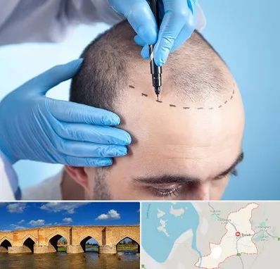 دکتر کاشت مو در بناب