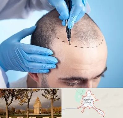 دکتر کاشت مو در تویسرکان