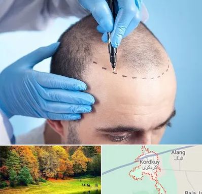 دکتر کاشت مو در کردکوی