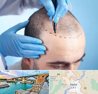 دکتر کاشت مو در دزفول