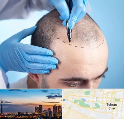 دکتر کاشت مو در غرب تهران 